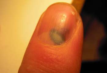[Bild: Mitt vänstra pekfinger finger efter ett hammarslag]
